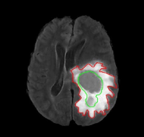 Segmentation annotation of a diagnostic brain scan